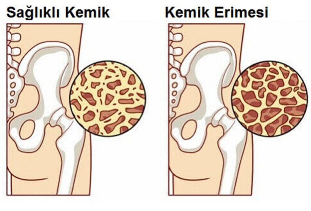 Osteoporoz ( Kemik erimesi ) 3
