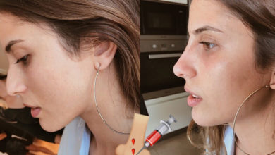 Ameliyatsız Burun Kaldırma Nedir ? Nasıl Uygulanır ? 1