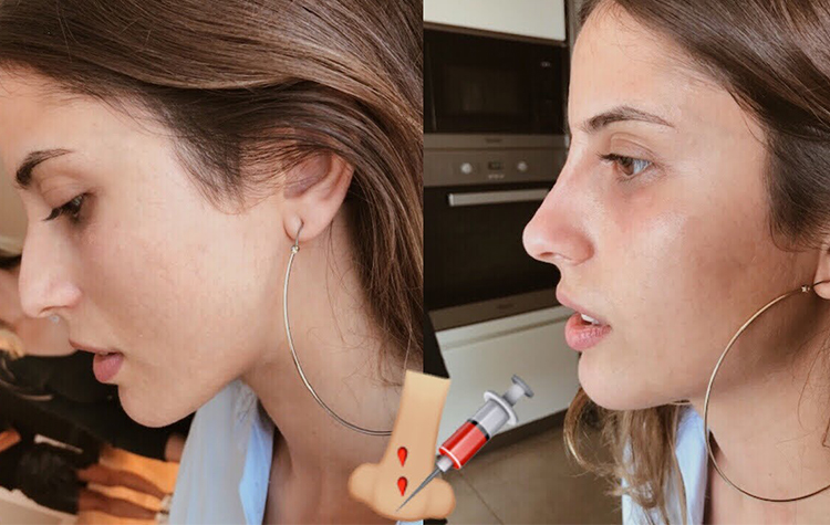 Ameliyatsız Burun Kaldırma Nedir ? Nasıl Uygulanır ? 7