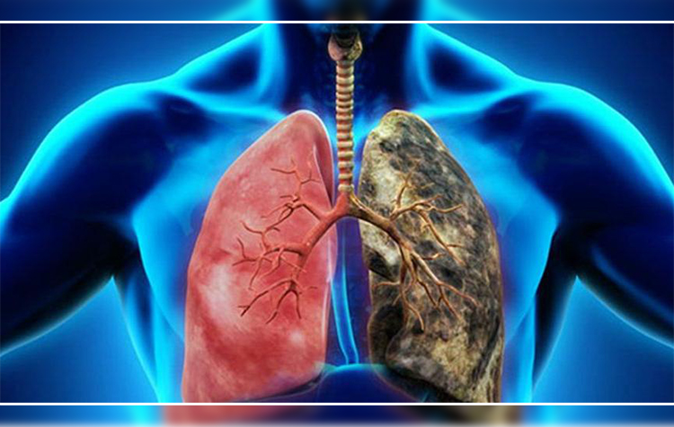 Akciğer Kanseri Nedir? Belirtileri ve Tedavisi 7