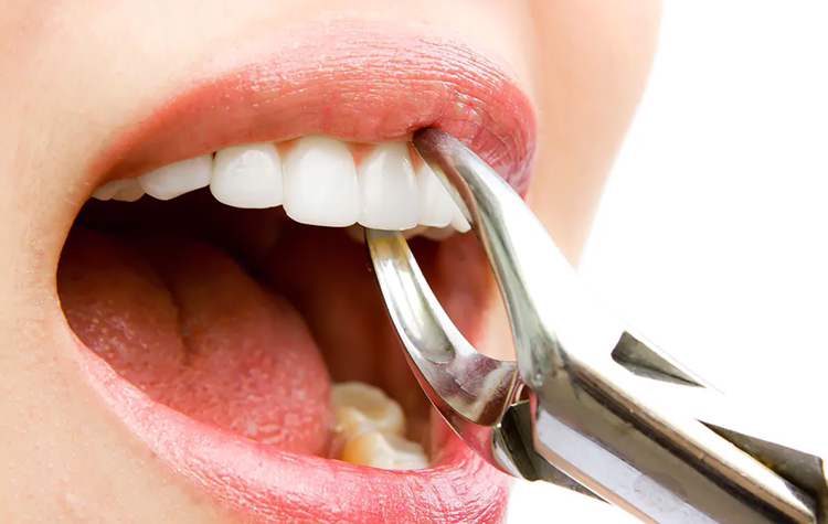 Ağızdaki En Büyük Tehlike 20 Yaş Dişleri ! 7