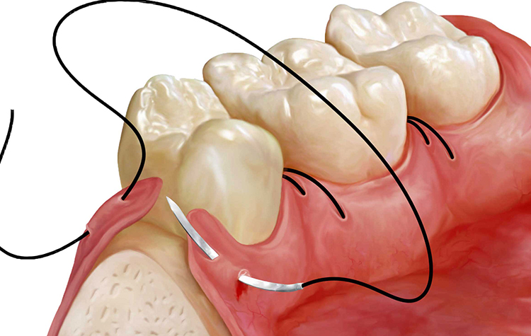 Diş eti enfeksiyonu bağışıklık sistemini olumsuz etkiliyor ! 7