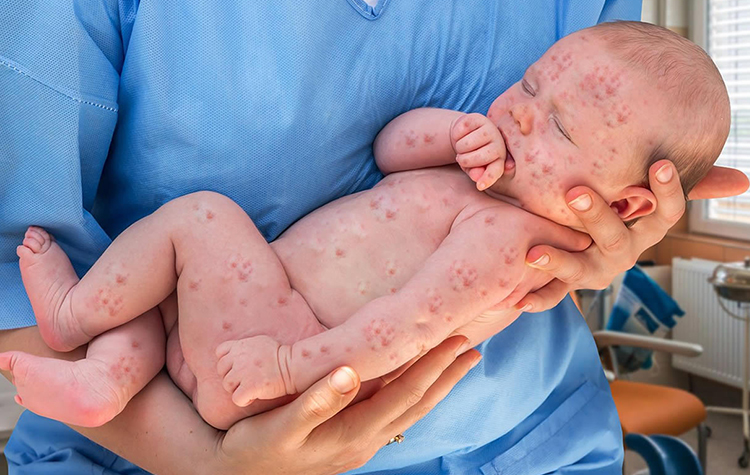 Kızamık Belirtileri Nedir? Kızamık Tedavisi 7