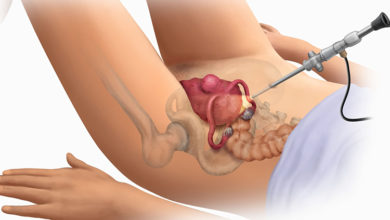 Miyom Nedir: Miyomlar alınmalı mı, alınmamalı mı? 1