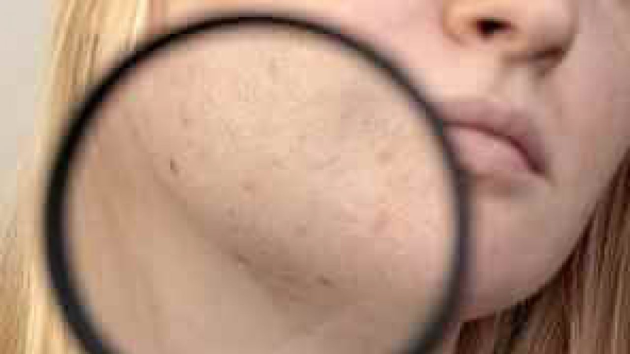 Güneş lekelerini önlemek için güneşten uzak durmak şart 7