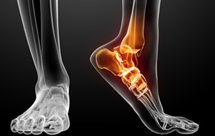 Ayak bileği ağrısı için artroskopik cerrahi 7