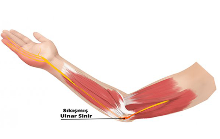 Dirsekte Sinir Sıkışması ( Ulnar Oluk Sendromu ) 8