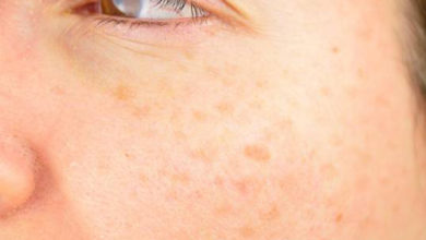 Güneş lekesi için kalıcı tedavi yöntemi var mıdır? 1