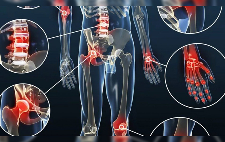 Bu belirtiler romatizmal hastalığın göstergesi olabilir 6