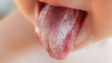 Bebeklerde pamukçuk nasıl geçer? 3