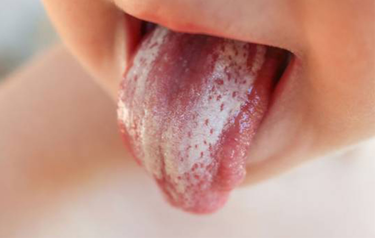 Bebeklerde pamukçuk nasıl geçer? 6