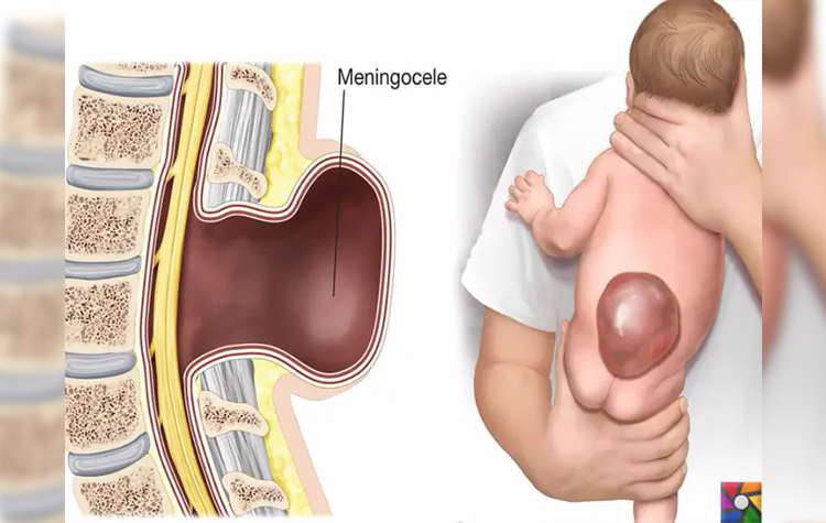 Spina Bifida ( Ayrık Omurilik Hastalığı ) 10