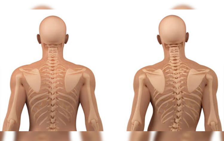 Skolyoz ( Omurga eğriliği ) 9