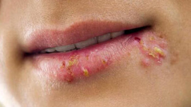 Uçuk Hastalığı ( Herpes Simpleks 44