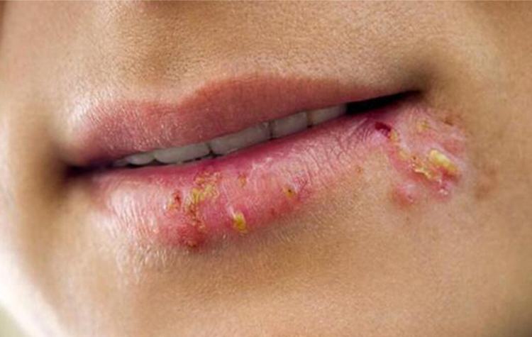 Uçuk Hastalığı ( Herpes Simpleks 7