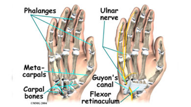 Guyon Kanalı Sendromu 43