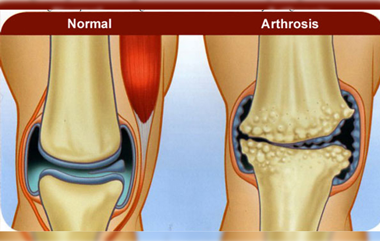 Kireçlenme Nedir ( Artroz-Osteoartrit ) 8