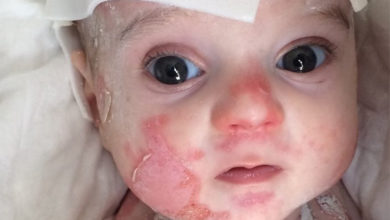 Kelebek hastalığı ( Lupus ) nedir? 28