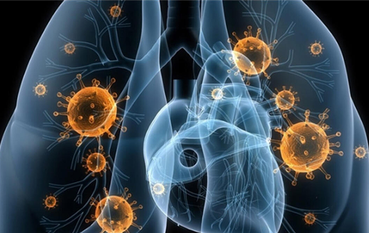 Zatürre ( Pnömoni ) nedir? 8