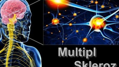 Multipl Skleroz (MS) 9