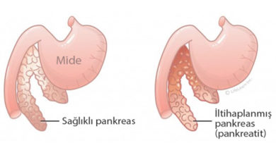 Pankreas iltihabı ( Pankreatit ) 6
