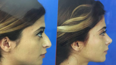 Burun Estetiğinde Önemli Olan Yüze Uygunluk 1