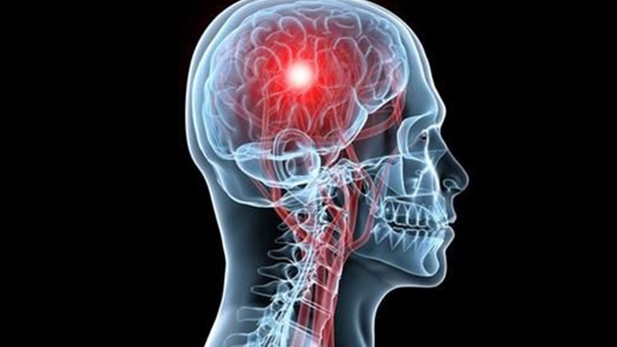 8 Soruda Yüz Felci 7