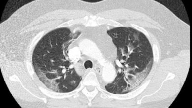 Günlerce geçmeyince doktora gitti Korona virüsün yeni belirtisi bu 5
