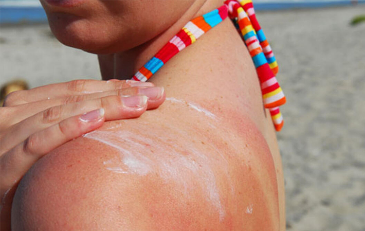 Güneş açık tenlileri ve çocukları daha hızlı yakıyor! 7