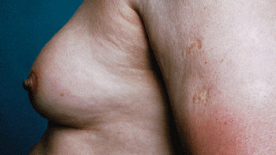 Bu Hastalık Erkeklerin Korkulu Rüyası 1