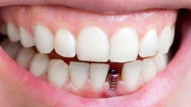 Diş Eksilmesine İmplant ile Son Veriliyor ! 8