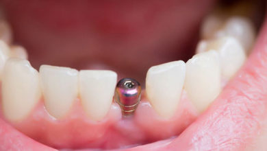 İmplant ile Diş Eksikliklerine Son Veriliyor 12