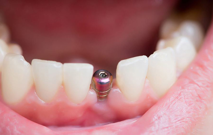 İmplant ile Diş Eksikliklerine Son Veriliyor 7