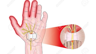 De Quervain Sendromuna Dikkat ! 22