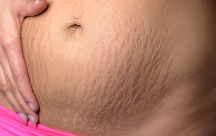 Vücutta Oluşan Çatlaklara Dikkat ! 7