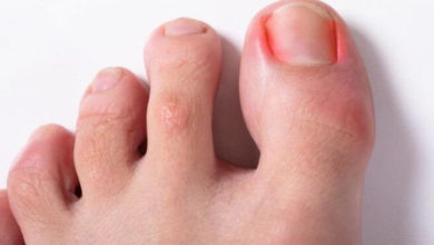 Tırnak Batmasına Kalıcı Çözüm ! 1