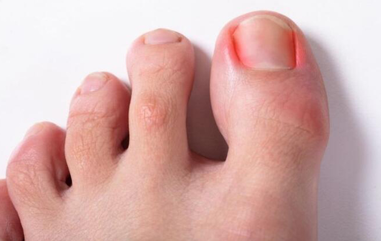 Tırnak Batmasına Kalıcı Çözüm ! 7