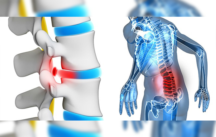 Hareketsizlik, obezite ve sigara kullanımı bel fıtığı yapıyor 7