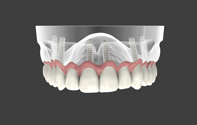 İmplant ile çene kemiğinizi koruyun 7