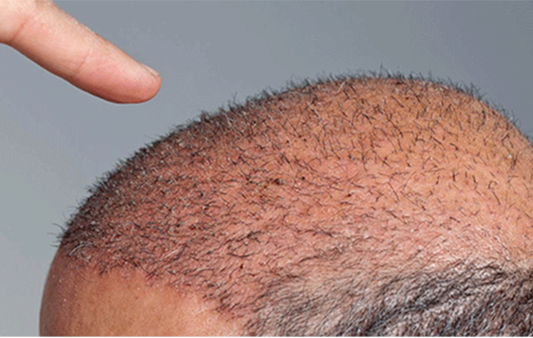 Dr. Emrah Çinik: Saç Ekimi Sonrasına Dikkat Çekti ! 7