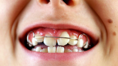 Çapraşık Dişler Nasıl Tedavi Edilir ? 6