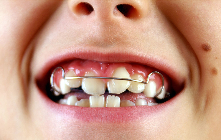 Çapraşık Dişler Nasıl Tedavi Edilir ? 7