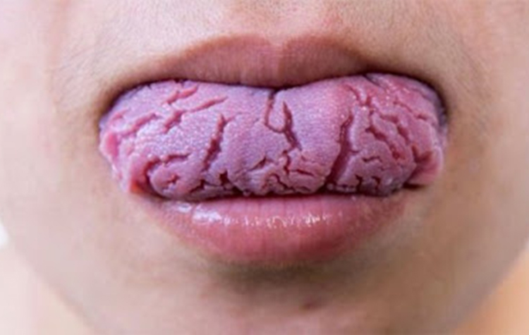 Harita dil kadınlarda daha sık görülüyor 7