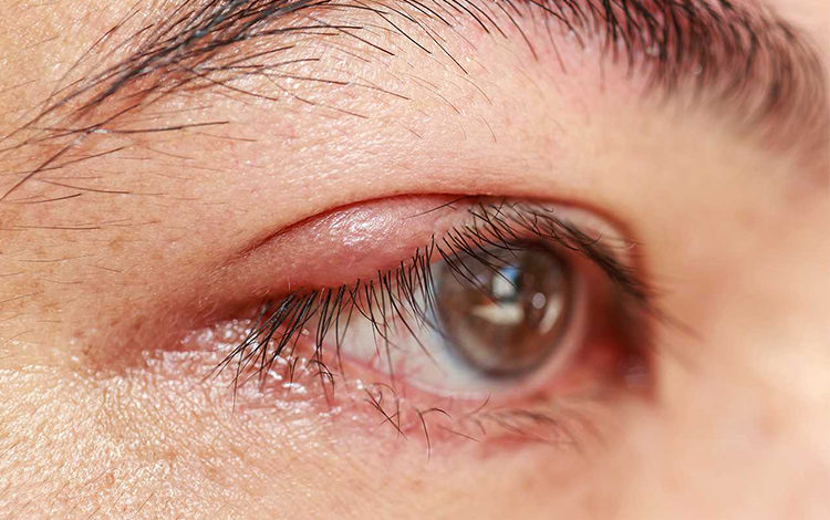 Kirli Eller Göz İltihaplanmasına Sebep Oluyor ! 1