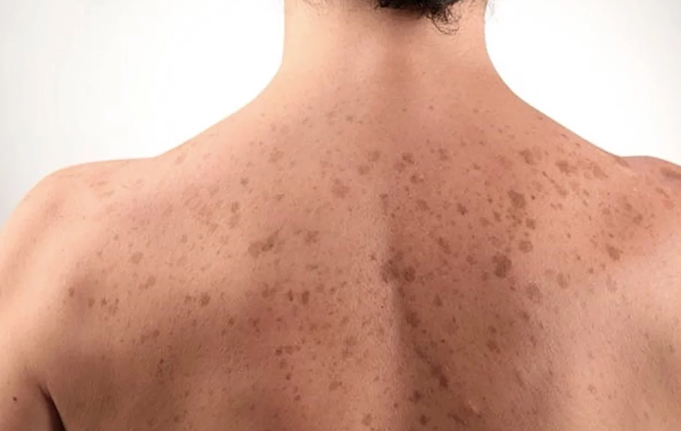 Vücuttaki Leke Problemine Dikkat ! 7