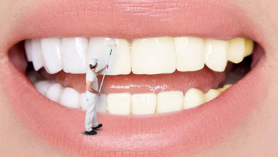 Diş Beyazlatırken Dikkat Edin 4