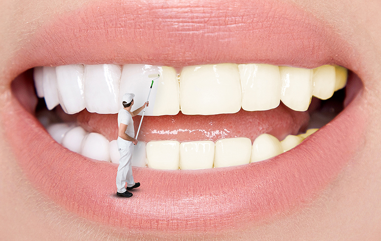 Diş Beyazlatırken Dikkat Edin 7