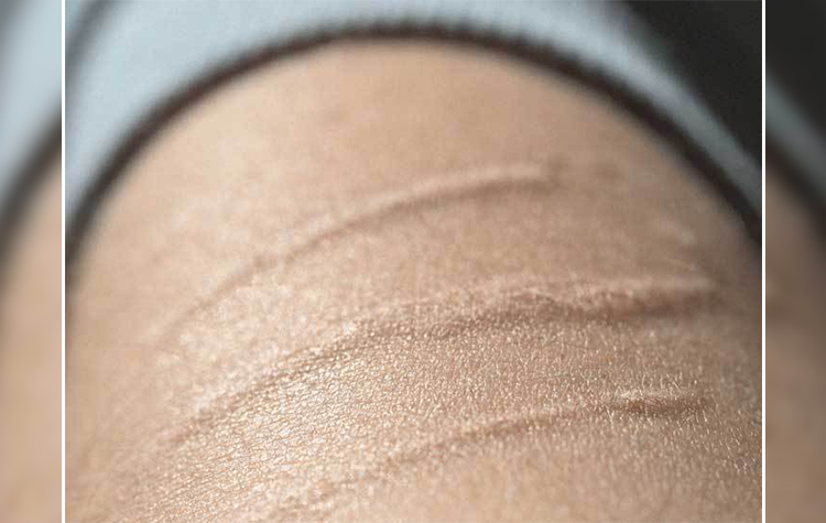 Yara ve ameliyat izlerinin tedavisi mümkün mü ? 6