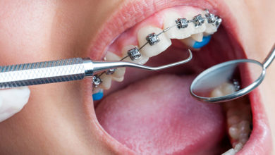 Dişlerde Oluşan Çapraşık Problemine Dikkat ! 2