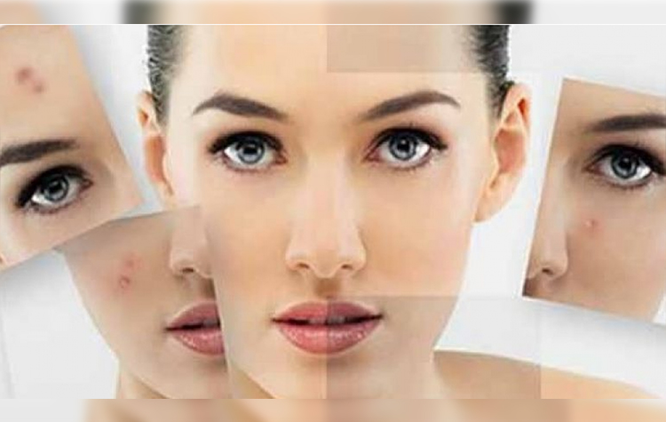 İlaç Kullanmadan Sivilce İzlerinden Kurtulmak Mümkün ! 7